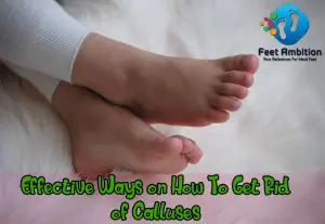 Effective Ways of Getting Rid of Calluses