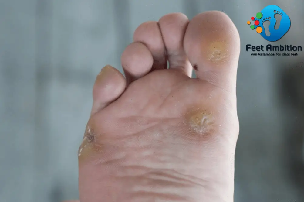 best way to remove corns on feet