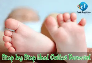 Step by Step Heel Callus Removal