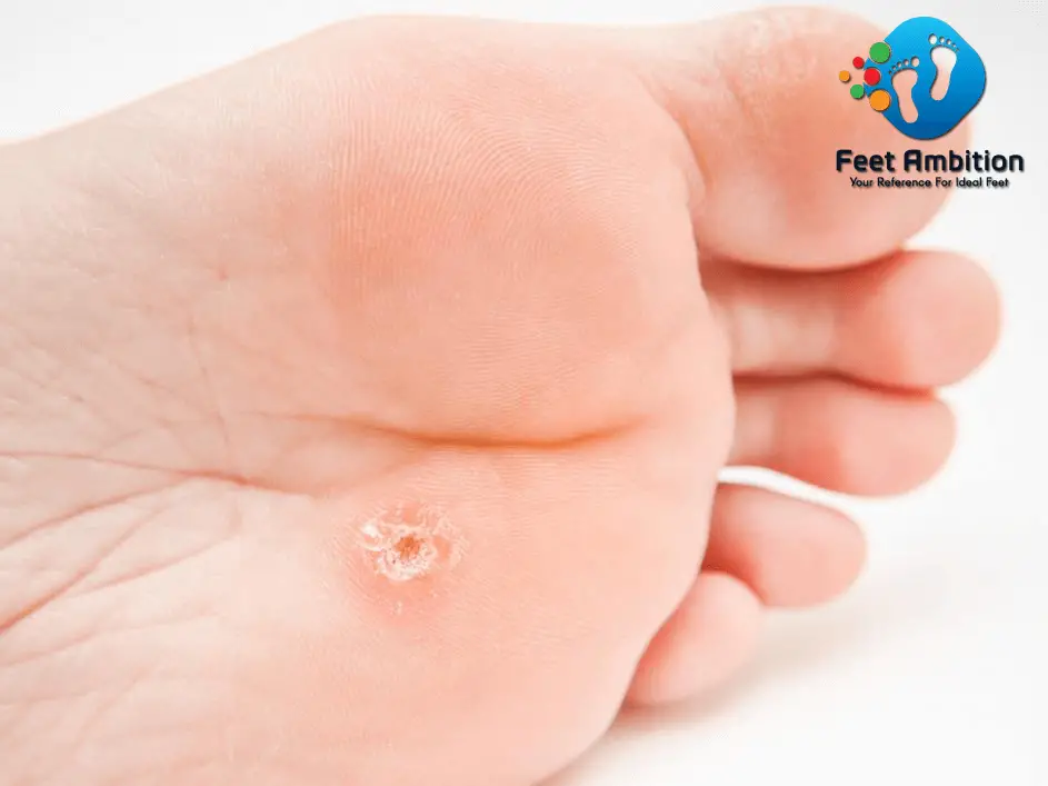 Symptoms Of Foot Corns1 Symptoms Of Foot Corns1