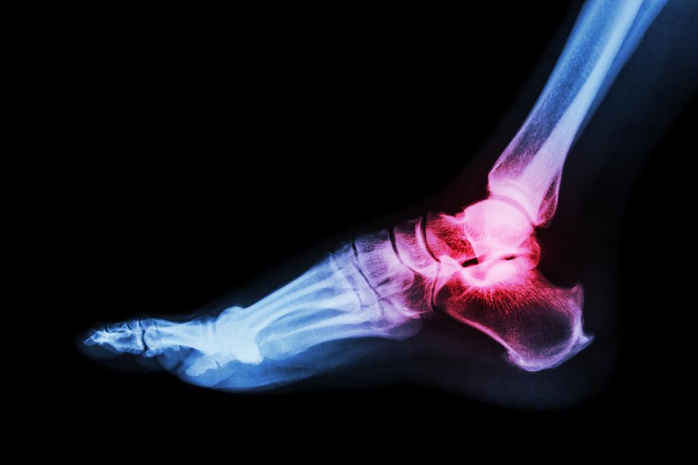 Is The Way You Walk A Reason For Calluses? Is The Way You Walk A Reason For Calluses?